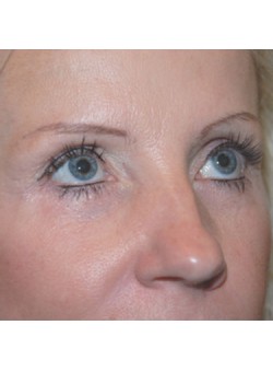After Image: Lower Eyelid - right-front-oblique