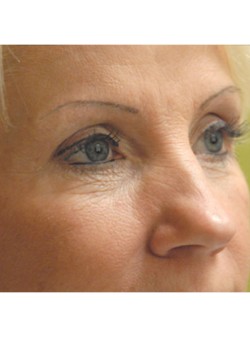 Before Image: Lower Eyelid - right-front-oblique