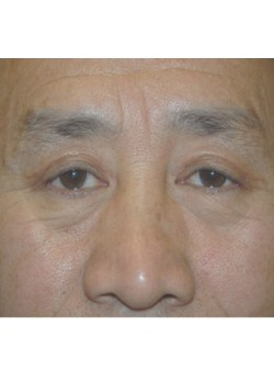 After Image: Upper Eyelid - front