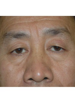 Before Image: Upper Eyelid - front