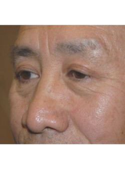 After Image: Upper Eyelid - left-front-oblique