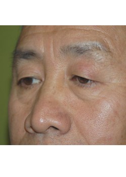 Before Image: Upper Eyelid - left-front-oblique