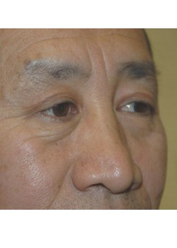 After Image: Upper Eyelid - right-front-oblique