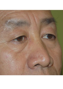 Before Image: Upper Eyelid - right-front-oblique