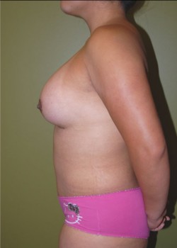 After Image: Tummy Tuck, Liposuction, Breast Augmentation - other