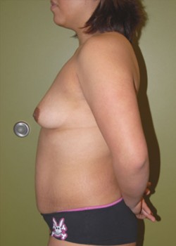 Before Image: Tummy Tuck, Liposuction, Breast Augmentation - other