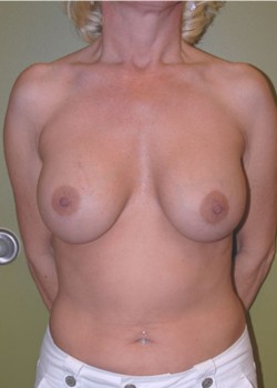 Before Image: Tummy Tuck, Liposuction, Breast Augmentation - front