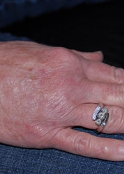 After Image: Fat Transfer To Hand - other