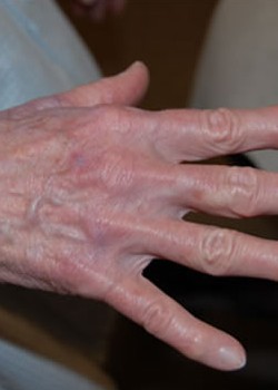 Before Image: Fat Transfer To Hand - other
