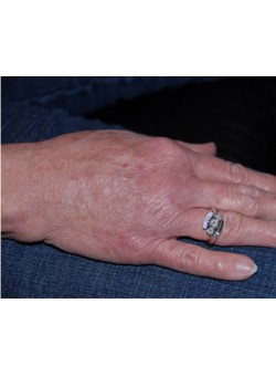 After Image: Fat Transfer To Hand - right-front-oblique