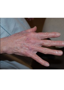 Before Image: Fat Transfer To Hand - right-front-oblique