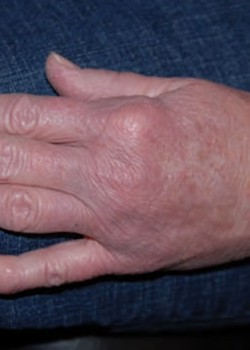 After Image: Fat Transfer To Hand - other