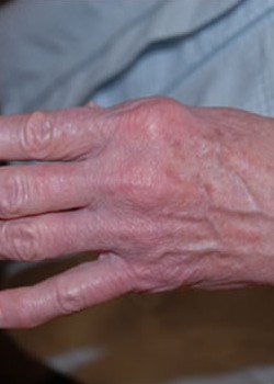 Before Image: Fat Transfer To Hand - other