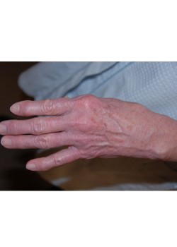Before Image: Fat Transfer To Hand - left-front-oblique