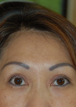 After Image: Asian Double Eyelid - front