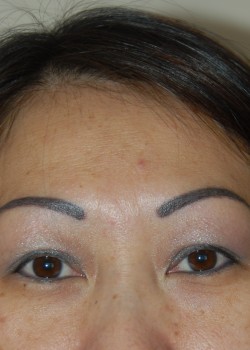 Before Image: Asian Double Eyelid - front