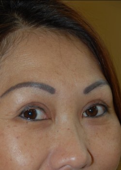 After Image: Asian Double Eyelid - right-front-oblique