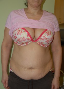 Before Image: Tummy Tuck with Liposuction - front