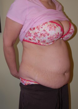 Before Image: Tummy Tuck with Liposuction - right-front-oblique