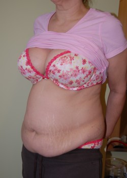 Before Image: Tummy Tuck with Liposuction - left-front-oblique