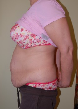 Before Image: Tummy Tuck with Liposuction - other