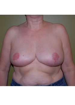After Image: Breast Reduction - front