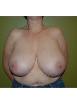 Before Image: Breast Reduction - front