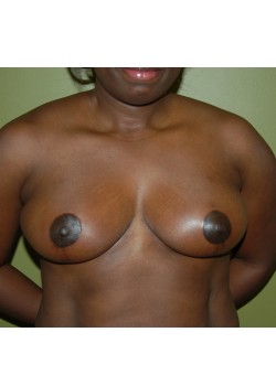 After Image: Breast Reduction - front