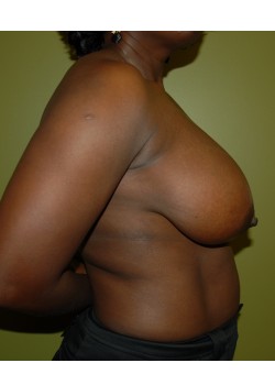 Before Image: Breast Reduction - other