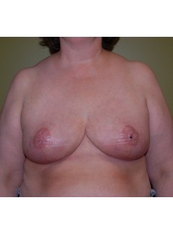 After Image: Breast Reduction - front
