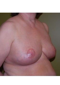 After Image: Breast Reduction - right-front-oblique