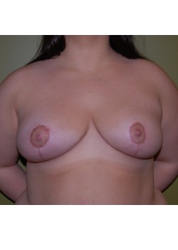 After Image: Breast Reduction - front