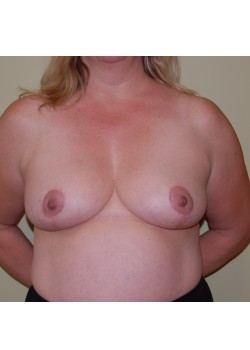 After Image: Breast Reduction - front