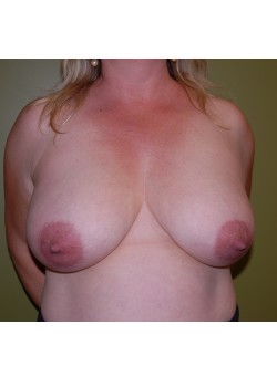 Before Image: Breast Reduction - front