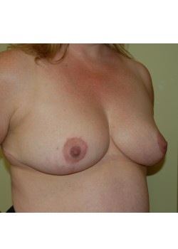 After Image: Breast Reduction - right-front-oblique