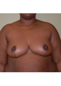 After Image: Breast Reduction - front