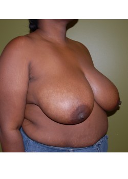 Before Image: Breast Reduction - right-front-oblique