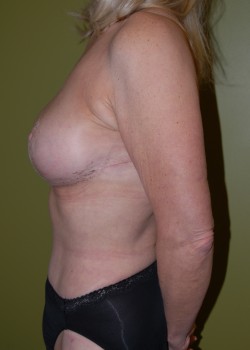 After Image: Tummy Tuck, Liposuction, Breast Reduction - other