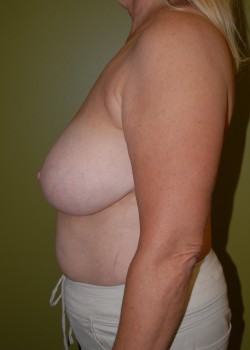 Before Image: Tummy Tuck, Liposuction, Breast Reduction - other