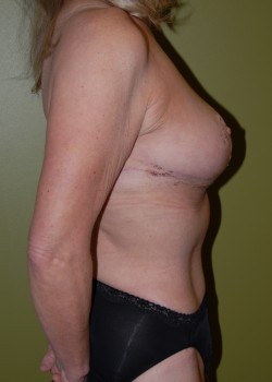 After Image: Tummy Tuck, Liposuction, Breast Reduction - other