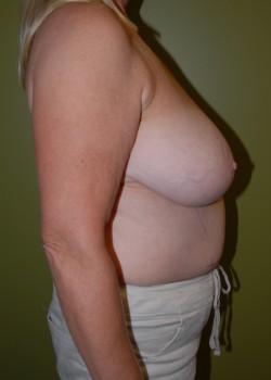 Before Image: Tummy Tuck, Liposuction, Breast Reduction - other