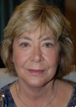 After Image: Face Lift, Upper and Lower Eyelid - front