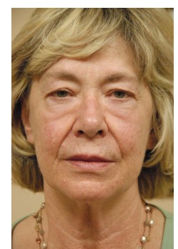Before Image: Face Lift, Upper and Lower Eyelid - front