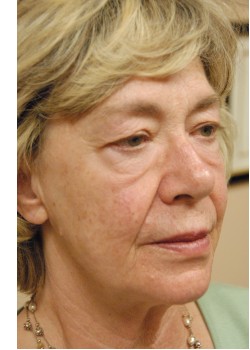 Before Image: Face Lift, Upper and Lower Eyelid - right-front-oblique