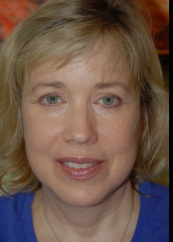After Image: Face Lift, Upper and Lower Eyelid - front