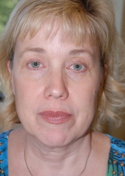 Before Image: Face Lift, Upper and Lower Eyelid - front