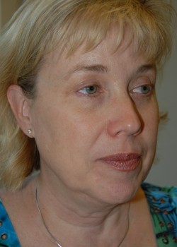 Before Image: Face Lift, Upper and Lower Eyelid - right-front-oblique