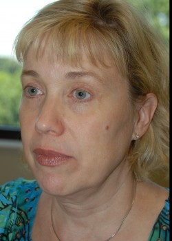 Before Image: Face Lift, Upper and Lower Eyelid - left-front-oblique