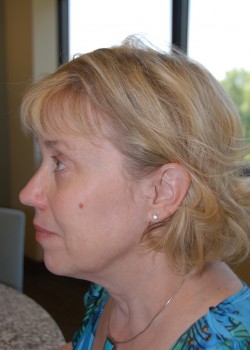Before Image: Face Lift, Upper and Lower Eyelid - other