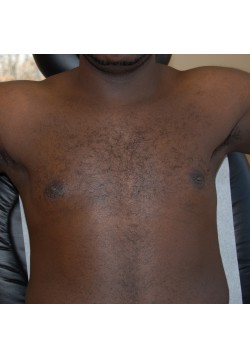 After Image: Gynecomastia (Male Breast Reduction) - front